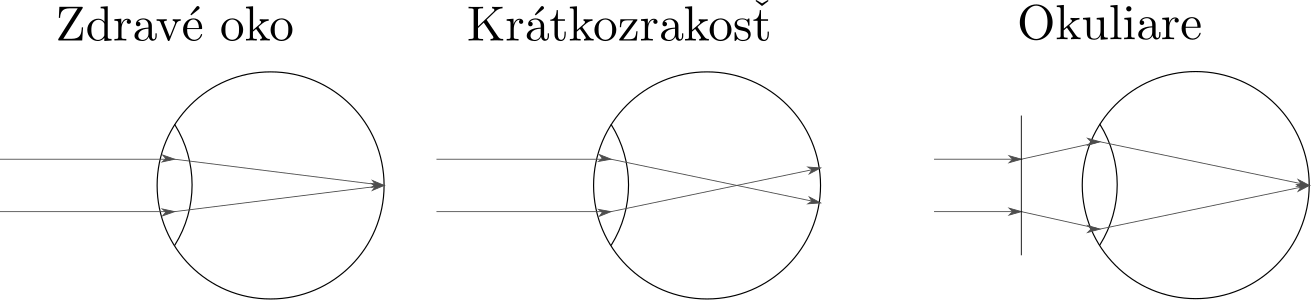Ako vyzará lámanie lúčov v oku